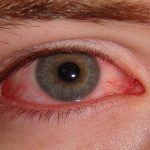 سندرم شوک سمی؛ هرآنچه باید بدانید 12 قرمزی چشم از علائم سندرم شوک سمی