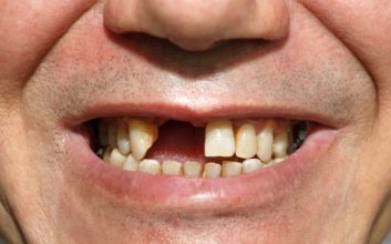 فردی بدون یک دندان جلو - پریودنتیت درمان‌نشده منجر به ازدست‌دادن دندان می‌شود