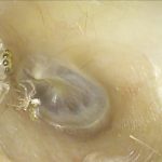 بیرون آوردن عنکبوت از یک گوش زن 64 ساله! + ویدیو 11 بیرون آوردن عنکبوت از یک گوش زن 64 ساله! + ویدیو