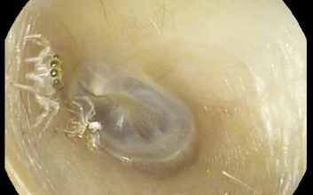 بیرون آوردن عنکبوت از یک گوش زن 64 ساله! + ویدیو