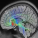 هوش مصنوعی سیگنال‌های مغزی مرتبط با بهبود افسردگی را شناسایی کرد