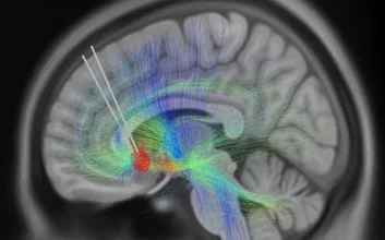 هوش مصنوعی سیگنال‌های مغزی مرتبط با بهبود افسردگی را شناسایی کرد