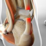 پارگی تاندون آشیل