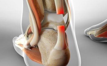 پارگی تاندون آشیل