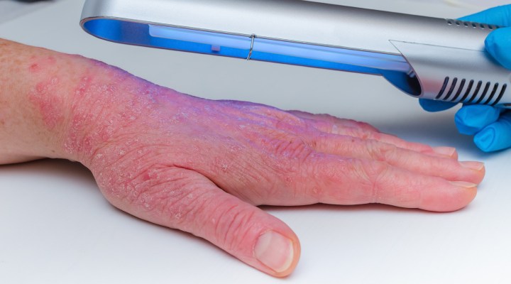 پیسی؛ انواع، علت، علائم و روش درمان 4 درمان پیسی با نوردرمانی