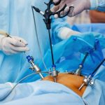 پزشکان در حال انجام عمل لاپاراسکوپی