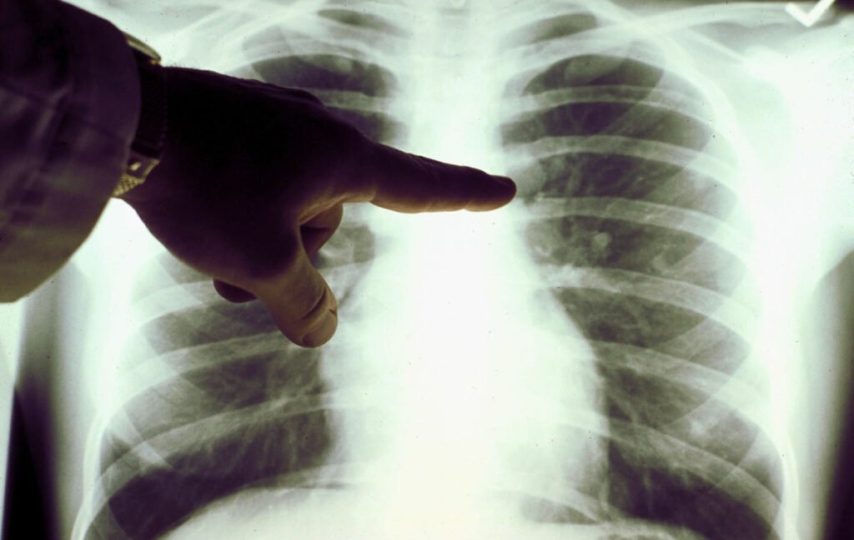 محققان یک قدم به درمان mRNA استنشاقی برای سرطان ریه نزدیک‌تر شدند