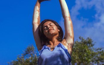 فردی که دست‌هایش دچار پیسی شده است