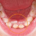 دندان اضافی از علائم سندرم گاردنر