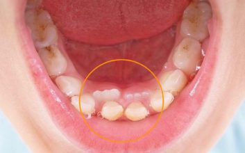 دندان اضافی از علائم سندرم گاردنر