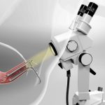 کولپوسکوپی - در طول کولپوسکوپی