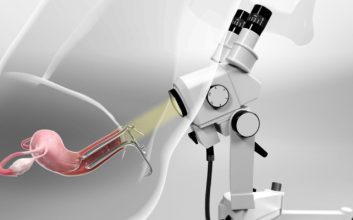 کولپوسکوپی - در طول کولپوسکوپی