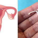 متروراژی و منومتروراژی؛ خونریزی غیرطبیعی سپس از پریود_دنیای تکنولوژی 3 آی یو دی از روشهای پیشگیری از بارداری که می تواند موجب متروراژی شود