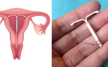 آی یو دی از روشهای پیشگیری از بارداری که می تواند موجب متروراژی شود