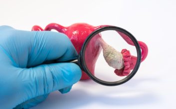 بررسی تخمدان با ذره‌بین