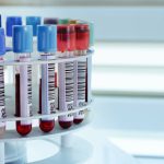 پیش‌بینی پارکینسون تا هفت سال زودتر با آزمایش خون