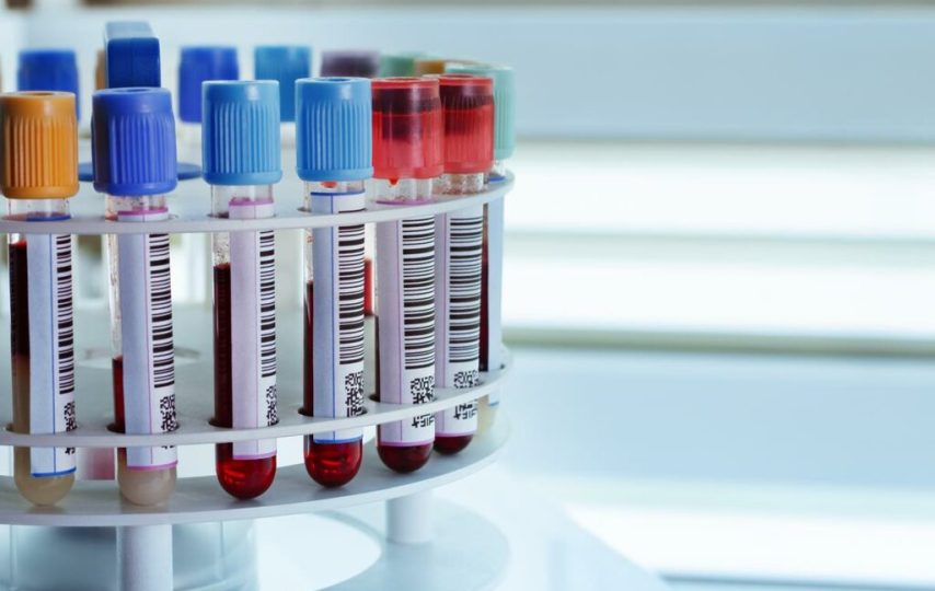 پیش‌بینی پارکینسون تا هفت سال زودتر با آزمایش خون