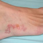 عفونت انگلی - عفونت انگلی - علائم عفونت انگلی