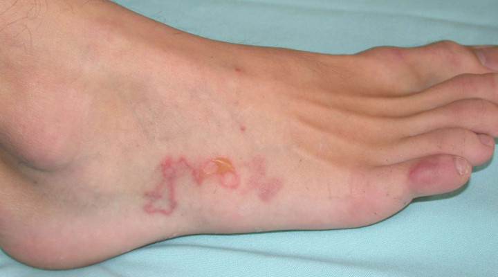 عفونت انگلی - عفونت انگلی - علائم عفونت انگلی