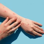 آبله میمون؛ راه‌های انتقال، تشخیص و پیشگیری