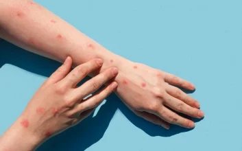 آبله میمون؛ راه‌های انتقال، تشخیص و پیشگیری