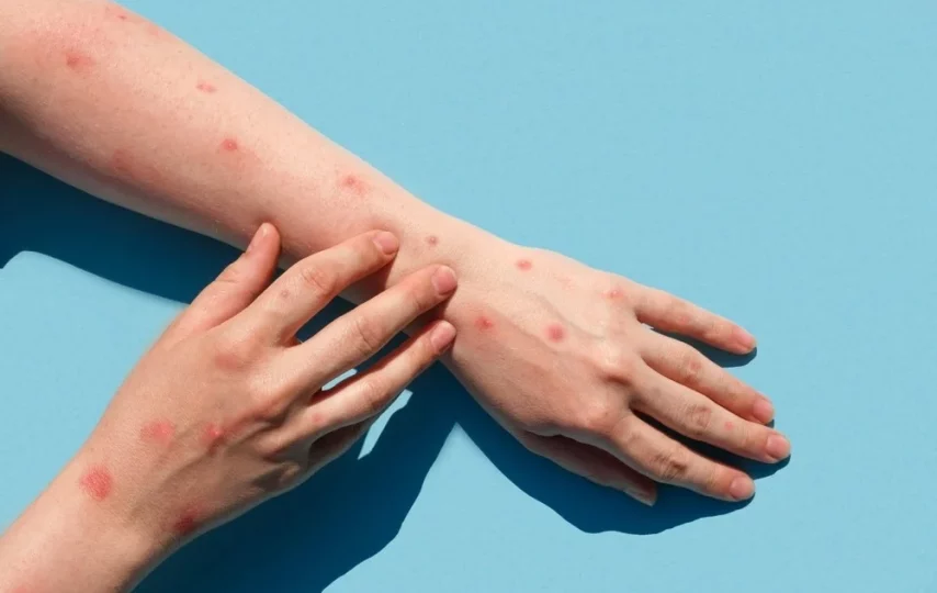 آبله میمون؛ راه‌های انتقال، تشخیص و پیشگیری