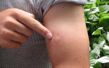 جای نیش پشه