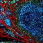 مبارزه با سرطان با پالس‌های الکتریکی با شدت کم