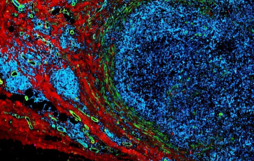 مبارزه با سرطان با پالس‌های الکتریکی با شدت کم