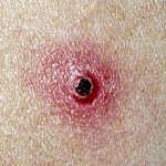 بیماری هایی که از گربه به انسان منتقل می‌شوند - بیماری خراش گربه یک بیماری مشترک بین انسان و گربه است که از طریق کنه یا چنگال گربه آلوده به انسان منتقل می شود.