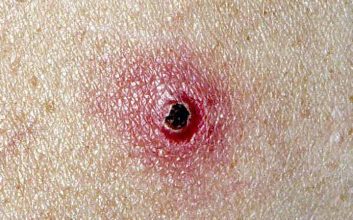 بیماری هایی که از گربه به انسان منتقل می‌شوند - بیماری خراش گربه یک بیماری مشترک بین انسان و گربه است که از طریق کنه یا چنگال گربه آلوده به انسان منتقل می شود.