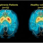 تشخیص دقیق اسکیزوفرنی با هوش مصنوعی BrainProbe در تایوان