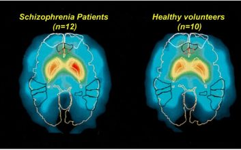 تشخیص دقیق اسکیزوفرنی با هوش مصنوعی BrainProbe در تایوان