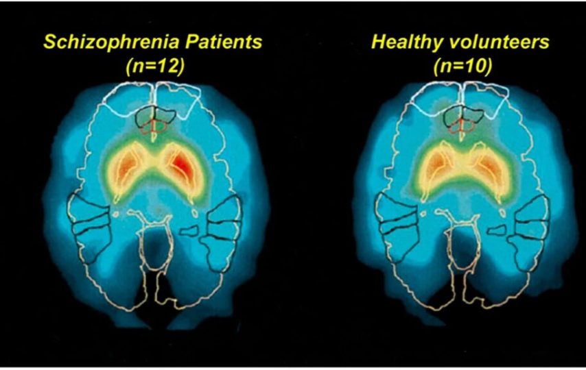 تشخیص دقیق اسکیزوفرنی با هوش مصنوعی BrainProbe در تایوان