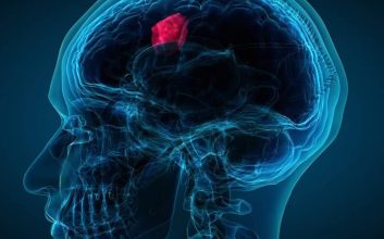 آلودگی هوا خطر ابتلا به تومور مغزی مننژیوم را افزایش می‌دهد