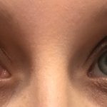 چربی داخل چشم پینگوکولا