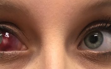 چربی داخل چشم پینگوکولا