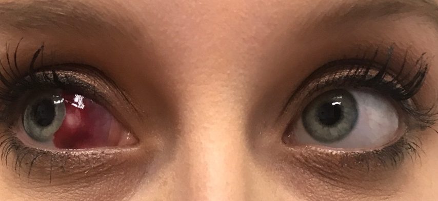 چربی داخل چشم پینگوکولا